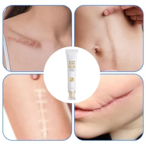Skin Scar Cream anti-acne cream Non-Greasy Old and New Scars Repair Cream Stretch Mark Removal Cream for Body Face Burns - Image 4