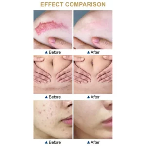 Skin Scar Cream anti-acne cream Non-Greasy Old and New Scars Repair Cream Stretch Mark Removal Cream for Body Face Burns - Image 5