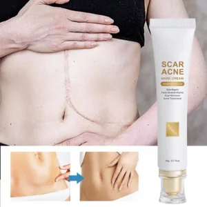 Skin Scar Cream anti-acne cream Non-Greasy Old and New Scars Repair Cream Stretch Mark Removal Cream for Body Face Burns - Image 3
